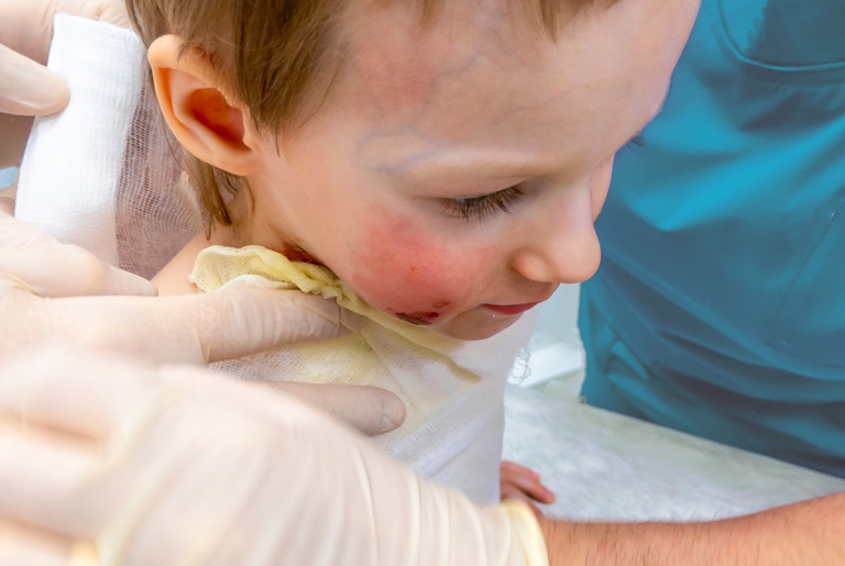 Read more about the article Suffering from a Burn Injury?